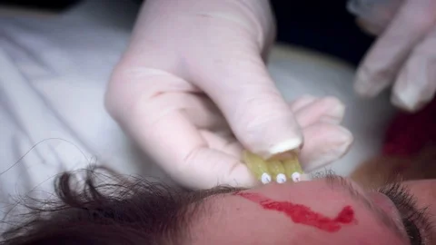 4K Doctor Applying PDO Thread Lifts in Woman Forehead Stock Footage 75844122