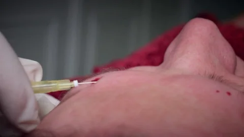 4K Doctor Inserting Thread Lift with Needle Stock Footage 75843601