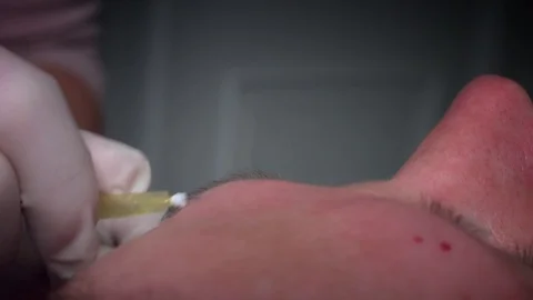 4K Doctor Inserting Thread Lift with Needle Stock Footage 75843768