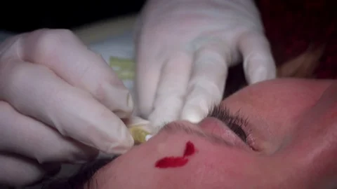 4K Doctor Inserting Thread Lift with Needle Stock Footage 75844090