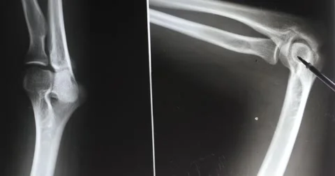 4k doctors study arm,leg joints X-ray film for analysis.medical health hospital Stock Footage 40340826