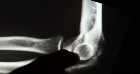4k doctors study arm,leg&amp;palm joints X-ray film for analysis on touch screen eq Stock Footage 40494569