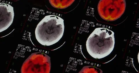 4k Doctors study head PET-ct skull brain scan X-ray film for analysis disease. Stock Footage 40495095
