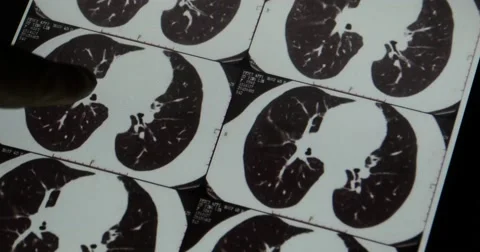 4k Doctors study head pet-ct skull brain scan X-ray film for analysis disease. 库存影片 40495842
