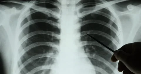 4k doctors study lung  X-ray film for analysis.medical health hospital. Stock Footage 40341299
