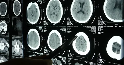 4k Doctors study skull brain X-ray film for analysis.health medical hospital. Stock-Footage 40342511