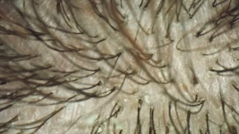 4k Extreme Close-up, Microscopic View of Human Hair and Scalp Stock Footage 107347180