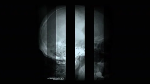 4k Human head bone skeleton skull X-ray scan,medical research body health&amp;death Stock Footage 46852508
