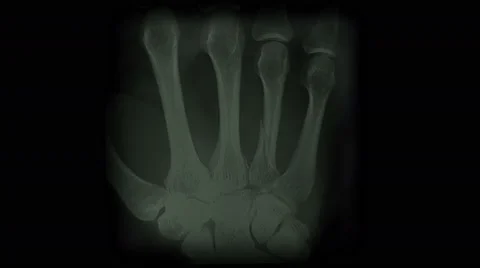 4k Human rib finger bone scan,tech medical X-ray,medical research,body health. Vidéo 46856989