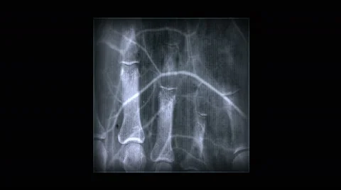 4k Human rib finger bone scan,tech medical X-ray,medical research,body health. Stock-Footage 46858836