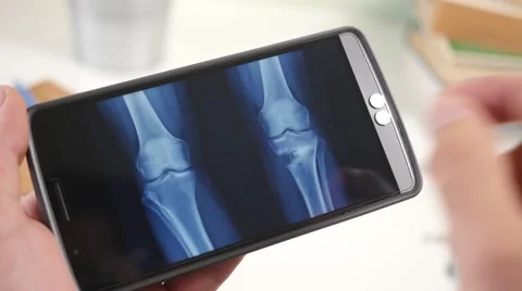 4K Looking At Xray Radiography on Smartphone - Leg Bones Stock Footage 67454893