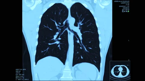 4K Lungs Ct Scan Frontal Stock Footage 152183698