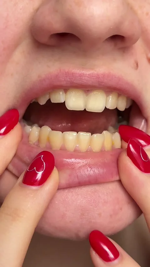 4k Macro video of yellow teeth. A close-up of a tooth, struck by caries. The Stock Footage 303699160