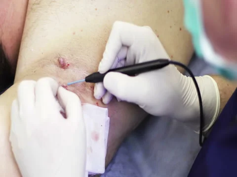 4K Plastic surgery. Close up Electrocoagulation of papillomas. Stock Footage 73385083
