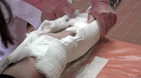 4k Removing plaster cast from child leg. Medical technician removing bandage Video stock 50692036