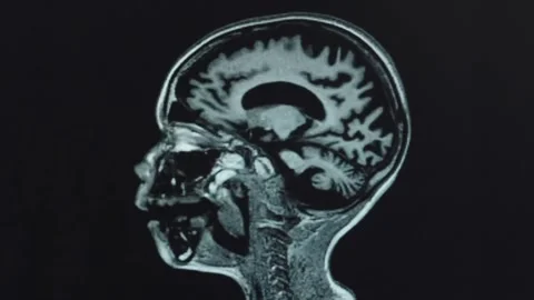 4K Sagittal View Human Brain MRI Scan T1-Weighted Neuroimaging Stock Footage 332157089