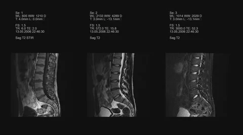 4k set of lower spine mri, Computed Tomography Stock Footage 63434102