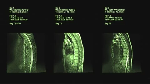 4k set of spine mri, Computed Tomography Stock Footage 63434095