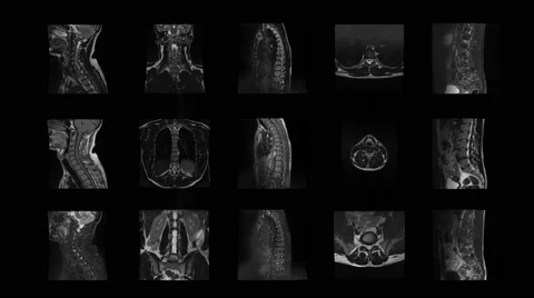 4k set of spine MRI, a real animated tomography of the spine Stock Footage 63229992