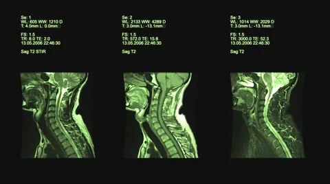 4k set of three neck views of MRI scan. Loopable. Green, Medical exam. Stock Footage