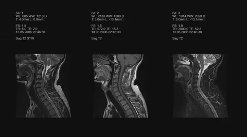4k set of three neck views of MRI scan. Loopable. Stock Footage 63434164