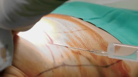 4k. Surgeon anesthetizing a patient. Stock Footage 75785329