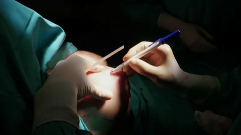 4k. The surgeon draws a circle around the nipple Stock Footage 75785688