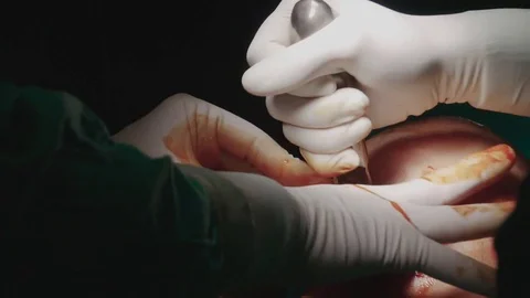 4k. The surgeon inserts the mammary prosthesis into the woman's chest Stock Footage 75785638