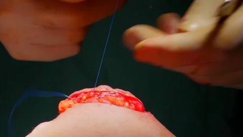 4k. The surgeon sews the incision in the patient's chest Stock Footage 75785953