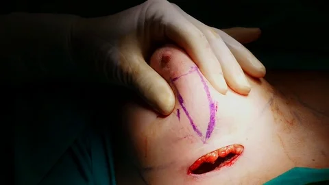 4k. The surgeon simulates the placement of the woman's chest where she should be Stock Footage 75785665