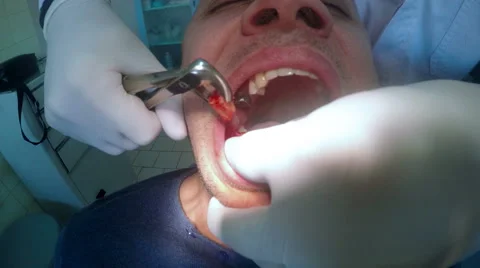 4K Tooth extraction. Dentist pulls the tooth out Stock Footage 50182107