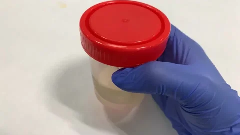 4K Urine Sample in Gloved Hand and Urine Analysis Stock Footage 135852043