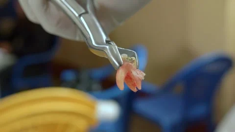 58 Closeup Of Pulled Tooth With Large Cavity Видео 347852975