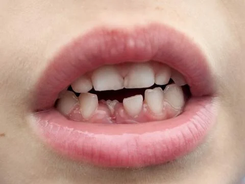 A 6-and-a-half-year-old boy lost his first milk tooth. Toothless boy 写真素材