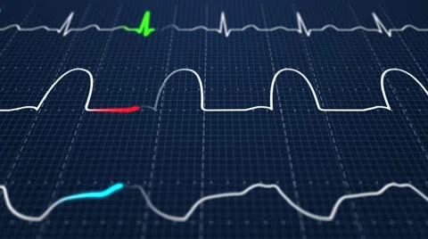 601 Electrocardiogram 003 B HD Stock Footage 26146820