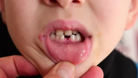 7-year-old child's primary tooth loss, a child with a missing anterior toot.. 動画素材 235931939