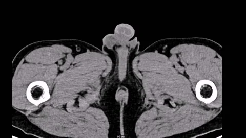 Abdomen 2mm Computed Tomography Vídeo Stock 196876685