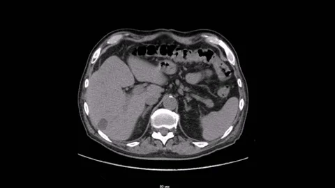Abdomen urolithiasis Computed Tomography Vídeo Stock 196876686