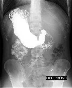 Abdomen x-ray Stock Photos