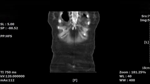 Abdominal-3 Stock Footage 98329643