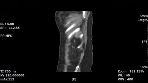 Abdominal-4 Stock Footage 98329687