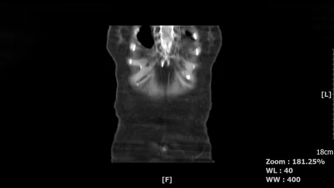 Abdominal-5 Stock Footage 112704851