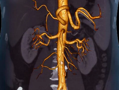 Abdominal aorta, 3D CT scan Stock Illustration