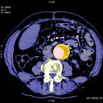  Abdominal aorta aneurysm, scan Axial CT scan. Aneurysm shown in yellow. C... Stock Photos