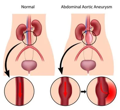 Abdominal aortic aneurysm Stock Illustration