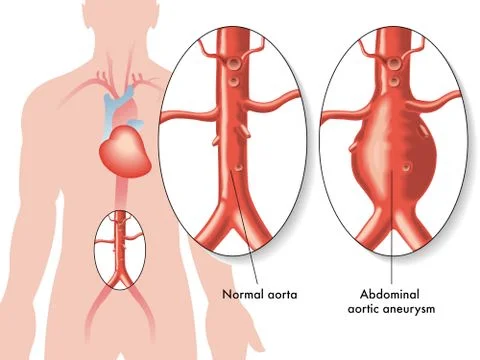 Abdominal aortic aneurysm Stock Illustration