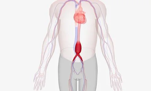 Abdominal aortic aneurysm occurs when the abdominal aorta balloons out due to Stock Illustration