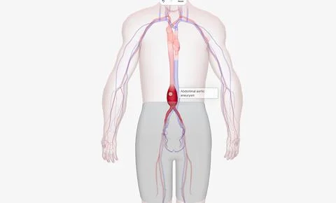 Abdominal aortic aneurysm occurs when the abdominal aorta balloons out due to Stock Illustration