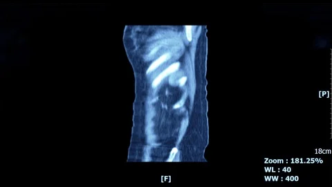 Abdominal blue 11 Stock Footage 122356854