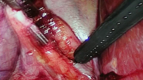 Abdominal cavity inside during operation laparoscopy. Stock Footage 82840596